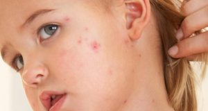 Д-р Ирина Млъзева, РЗИ – Велико Търново: В региона няма регистрирани случаи на морбили